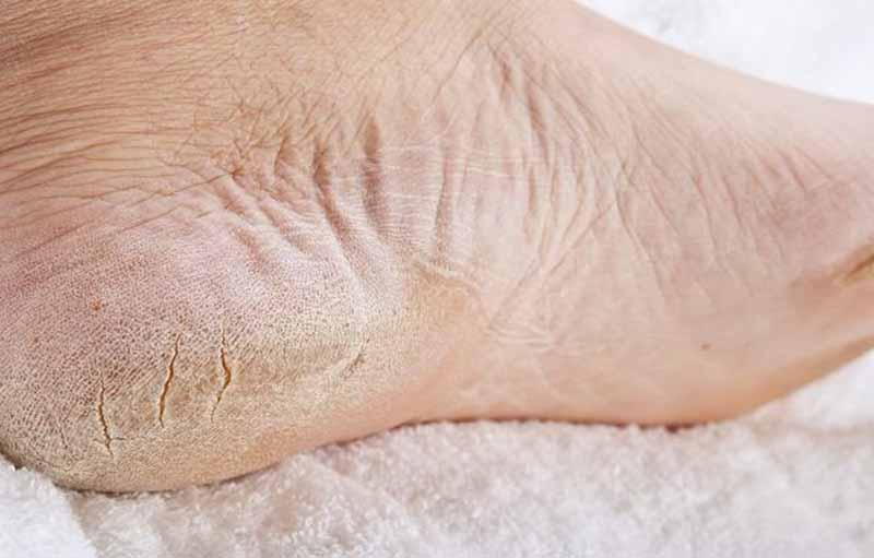 4 Krim Paling Bagus untuk Mengatasi Kulit Kaki Pecah dan Kering
